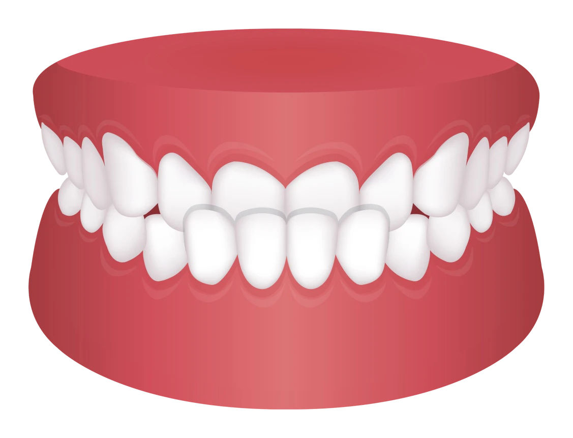Underbite